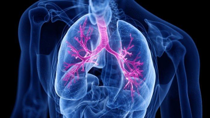 hati hati penyakit paru obstruktif kronik bisa berujung kecacatan 7a3dc2b